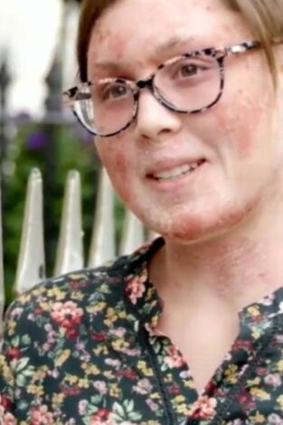 Dra. Emma: clínica dermatológica: Crisis de eccema